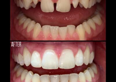 Invisalign before and after 2