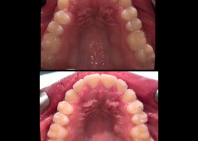 Invisalign before and after above